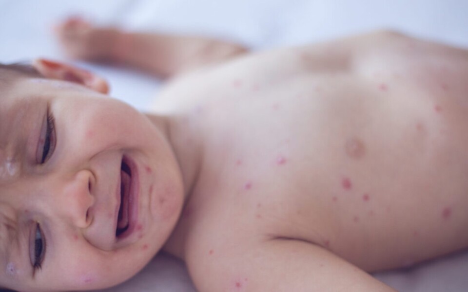Measles Kills 6-Week-Old Infant in Pennsylvania, Coroner Says