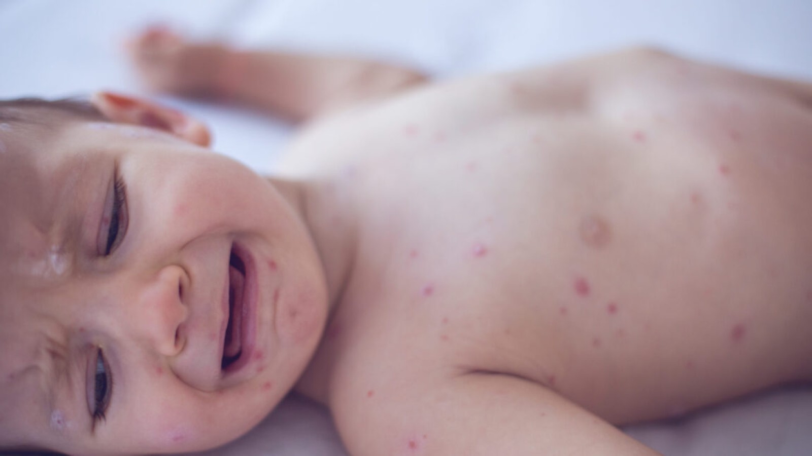 Measles Kills 6-Week-Old Infant in Pennsylvania, Coroner Says - measles infant death Pennsylvania
